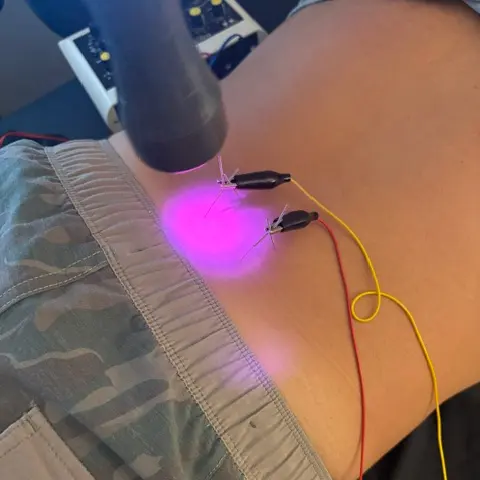 A laser wand glowing pink on a person's lower back, with small clips and red and yellow wires attached