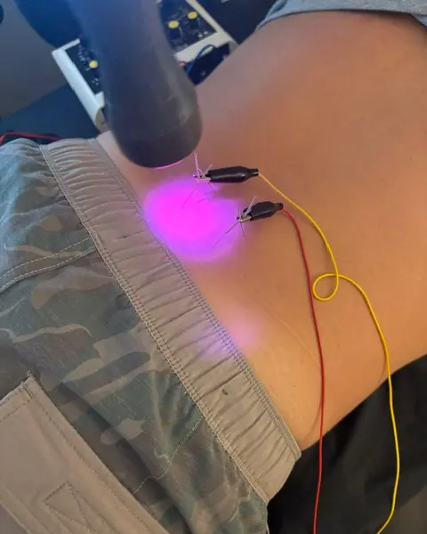 A laser wand glowing pink on a person's lower back, with small clips and red and yellow wires attached