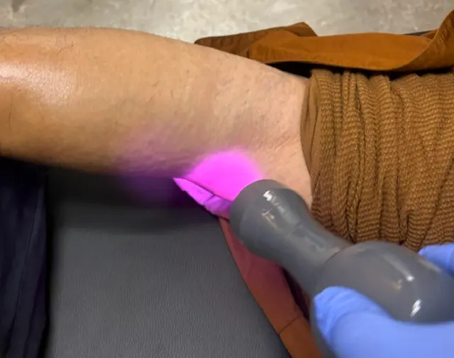 A gloved hand holds a laser device over a person's arm, which glows pink