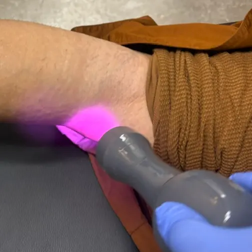A gloved hand holds a laser device over a person's arm, which glows pink
